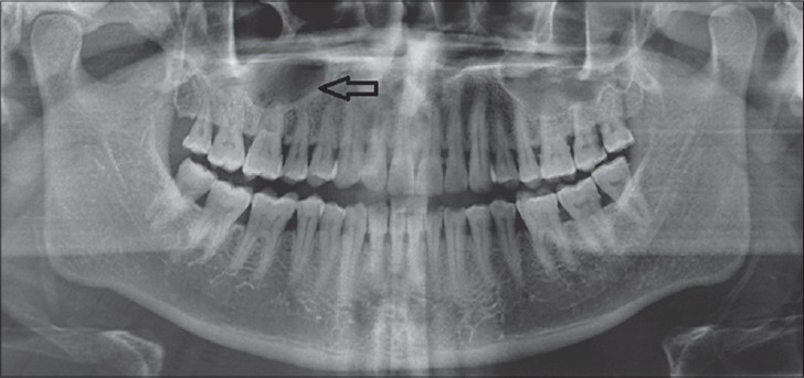 45-year-old male patient with lesion on the right side of the palate diagnosed as mucoepidermoid carcinoma – intermediate stage. Orthopantomograph shows radiolucency superimposing the right maxillary sinus (arrow).